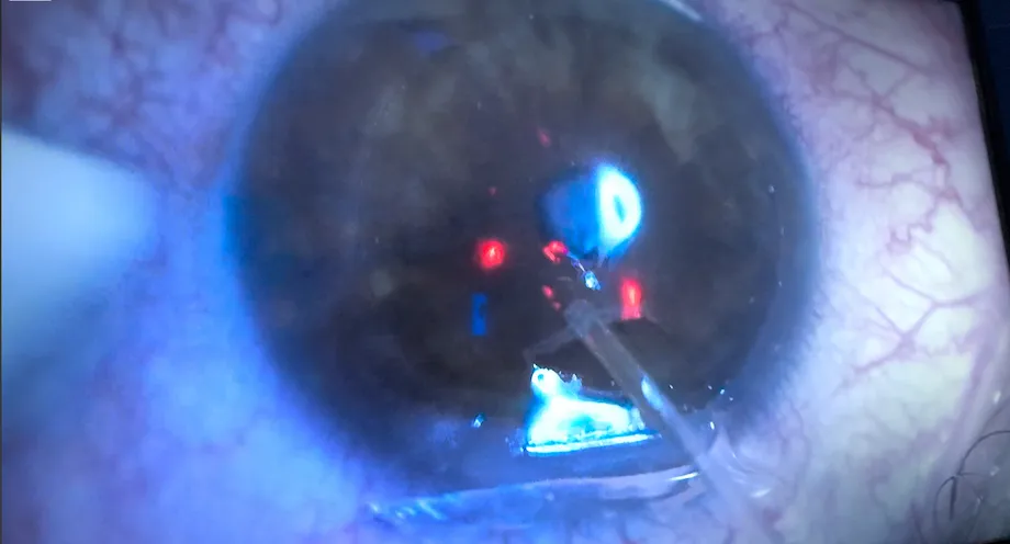 Close up of surgical procedure during zeiss medical video shooting